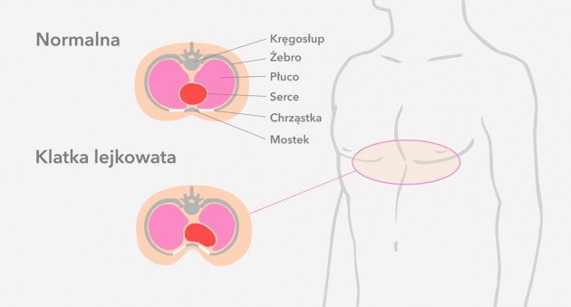 Klatka lejkowata Klatka lejkowata