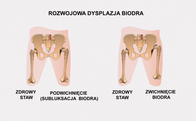 Dysplazja stawu biodrowego