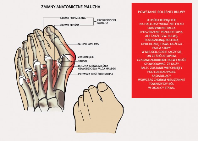 Paluch koślawy