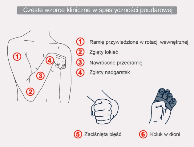 Spastyka poudarowa