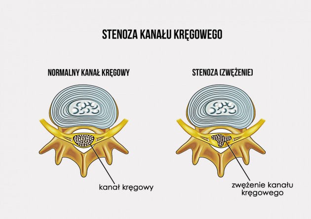 Stenoza